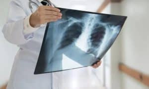 Καρκίνος πνεύμονα: Χορηγήθηκε πειραματικό εμβόλιο σε ασθενή στη Θεσσαλονίκη