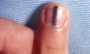 Μαύρη γραμμή στο νύχι: Πότε μπορεί να είναι σημάδι μελανώματος